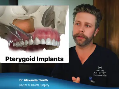 03 who is a candidate for all on x dental implants
