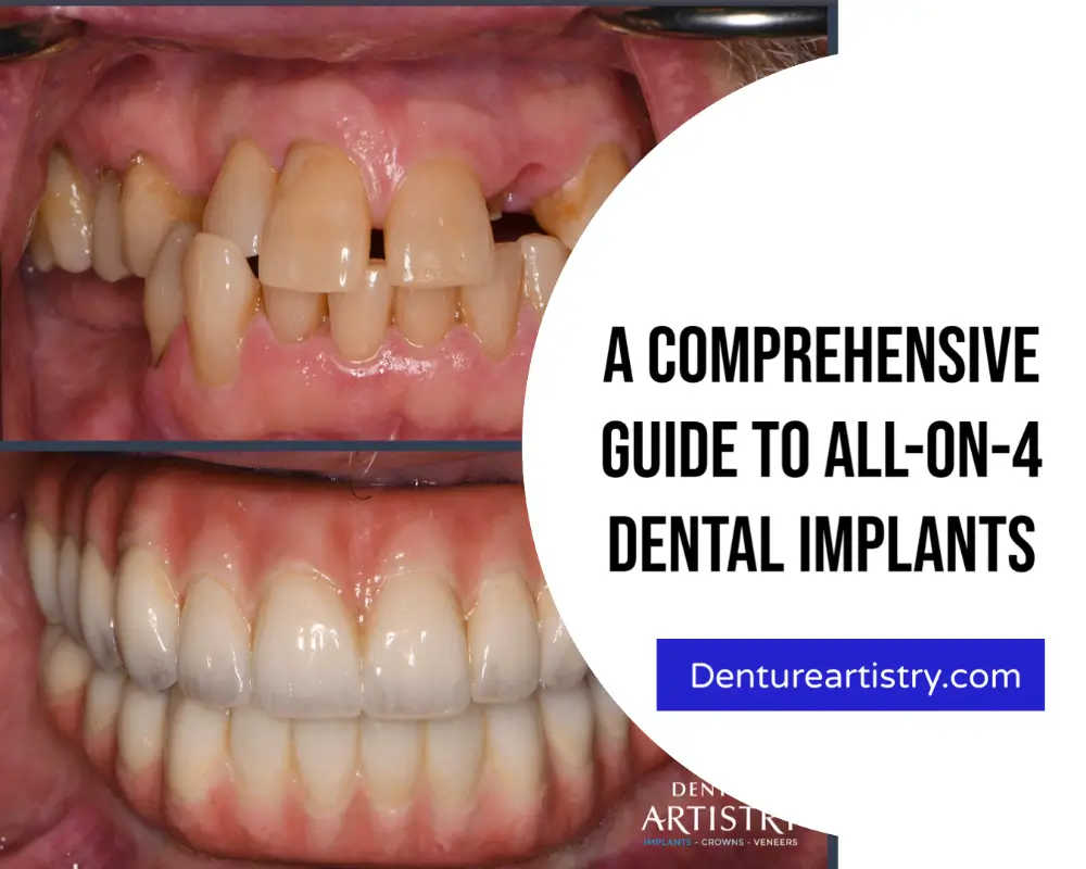 a comprehensive guide to all on 4 and full mouth implants