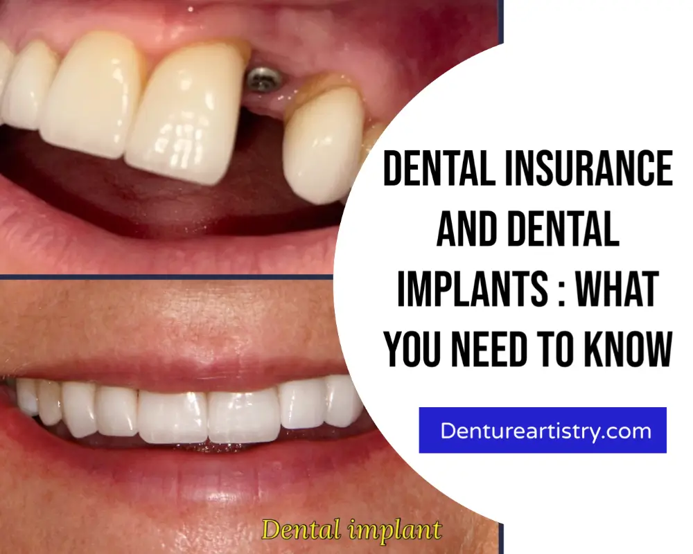 dental insurance and dental implants what you need to know