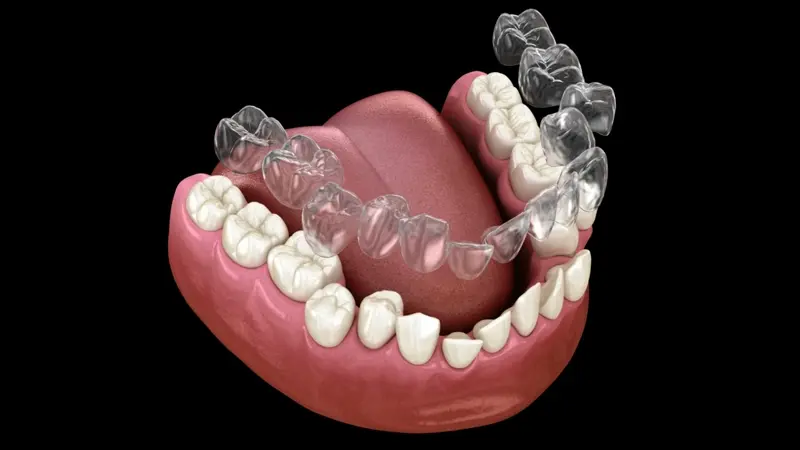 clear aligners