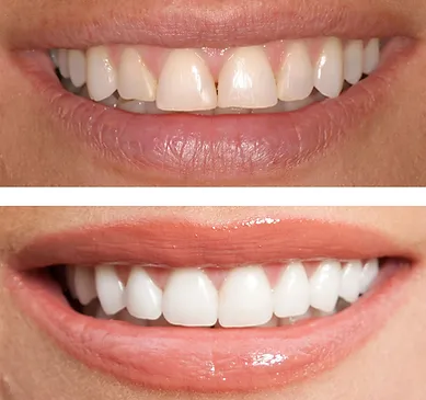 dental bonding1