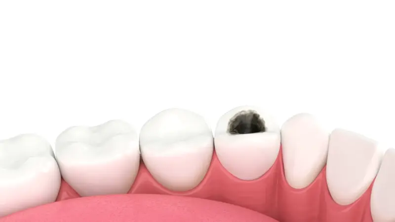 dental filling