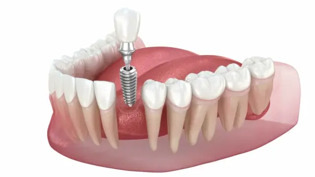 dental implants 2