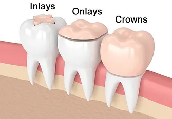 inlays outlays 2