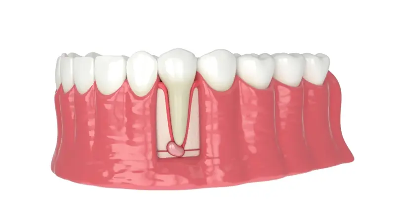 root canal