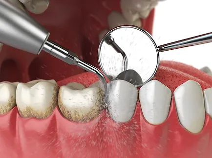 teeth cleaning1