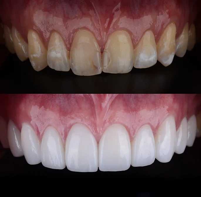 veneers 1
