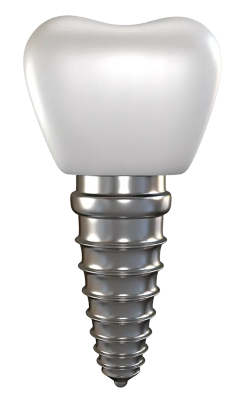 dental implants 2