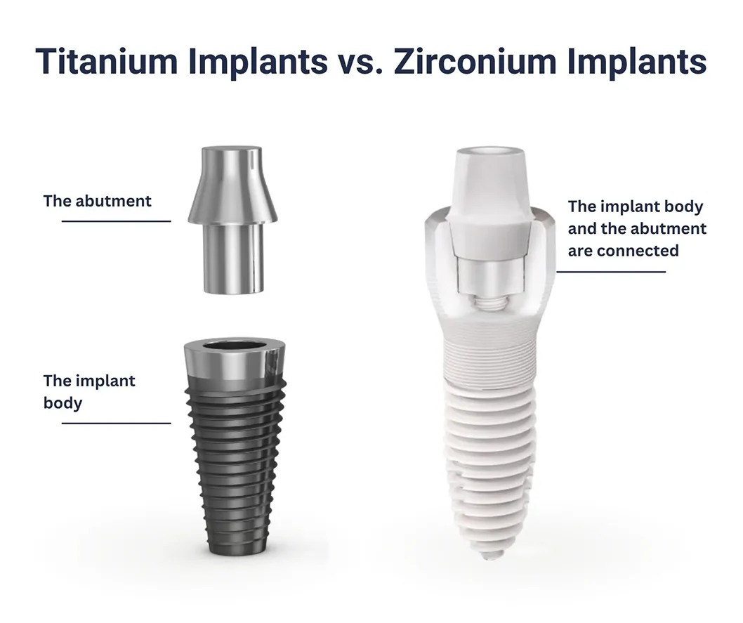 dental implants 3