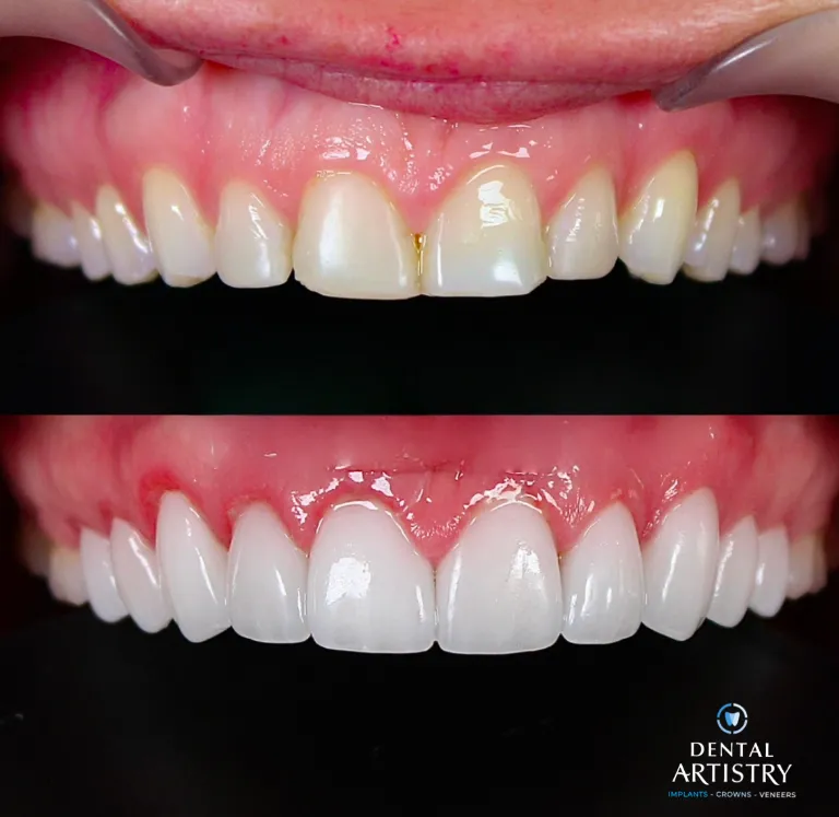 dental artistry crowns veneers