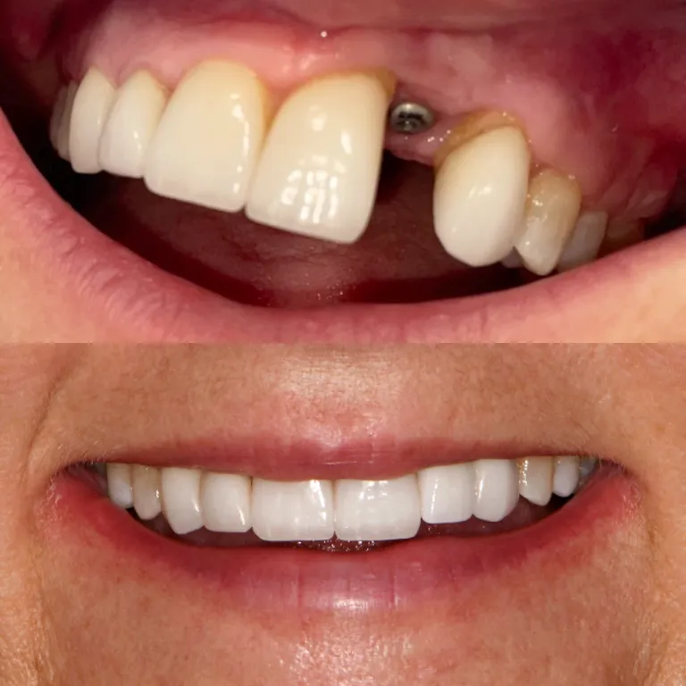 dental artistry dental implant