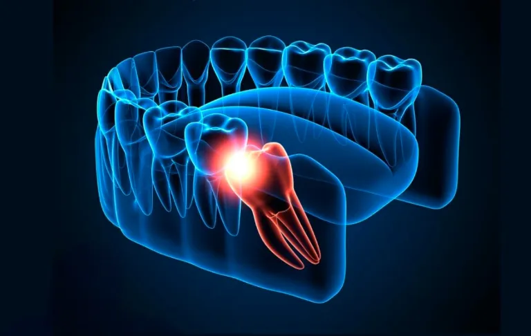 wisdom tooth