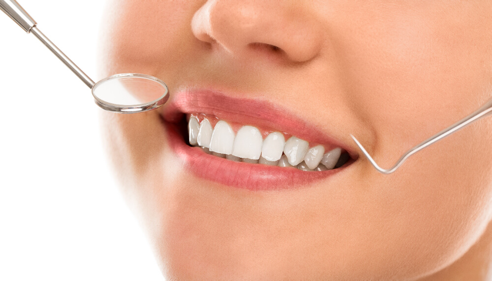 close-up shot of teeth with veneers
