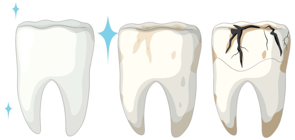 image showing a healthy teeth and two with progressing cavities